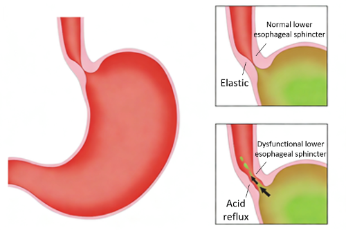 GERD Diagnosis Demystified: From Endoscopy to Non-Invasive Saliva Tests